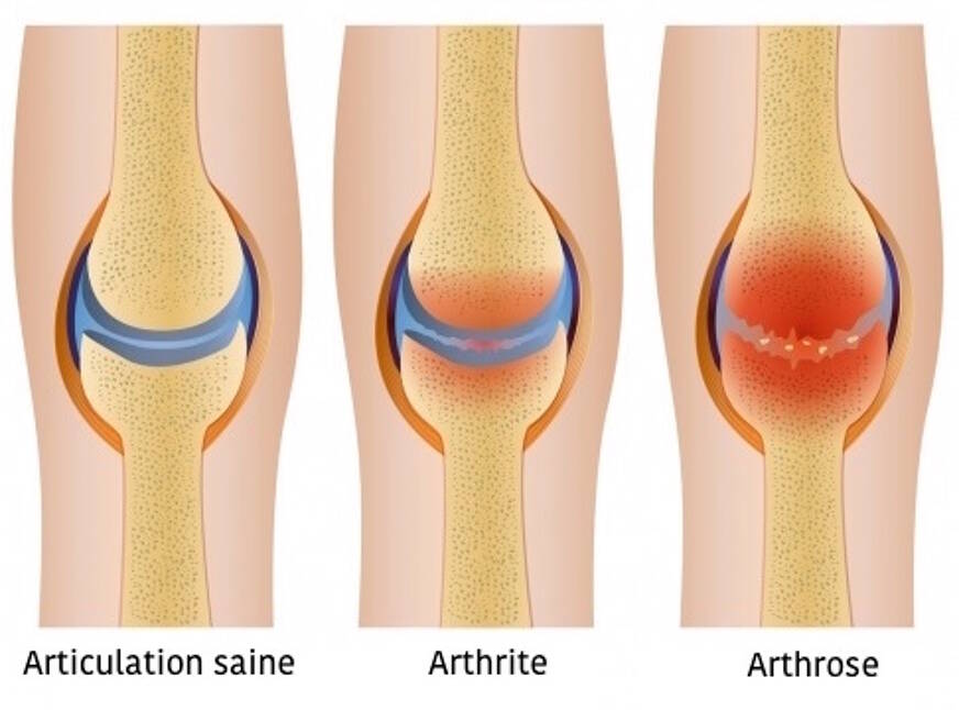 arthrose vs arthrite